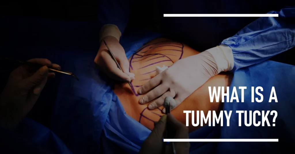 What is a Tummy Tuck?
