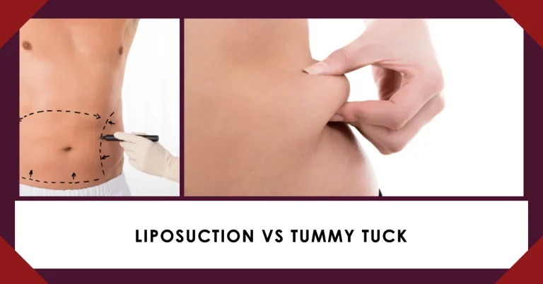 What’s the difference between liposuction and tummy tuck